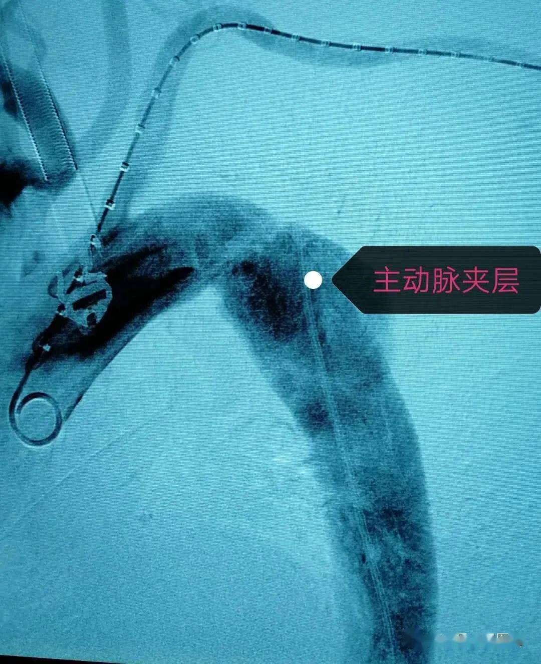 胸主动脉覆膜支架产品价格重新制定，惠泰医疗回应