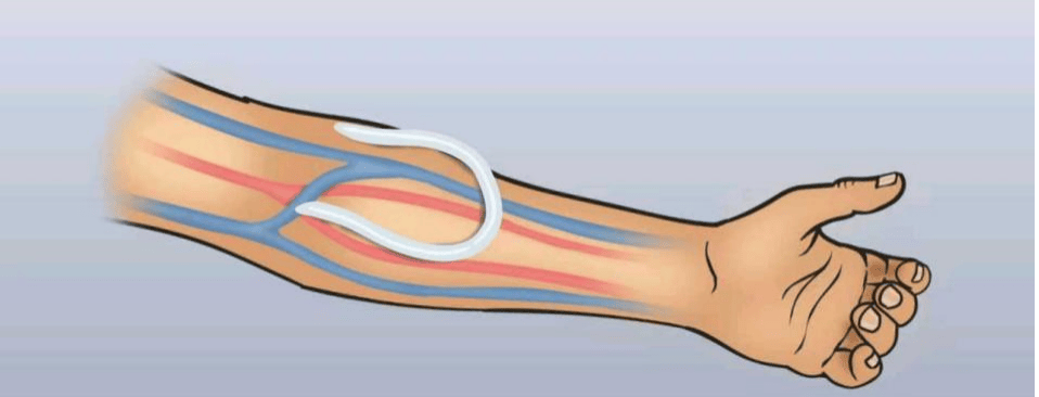 手臂里的“生命线”